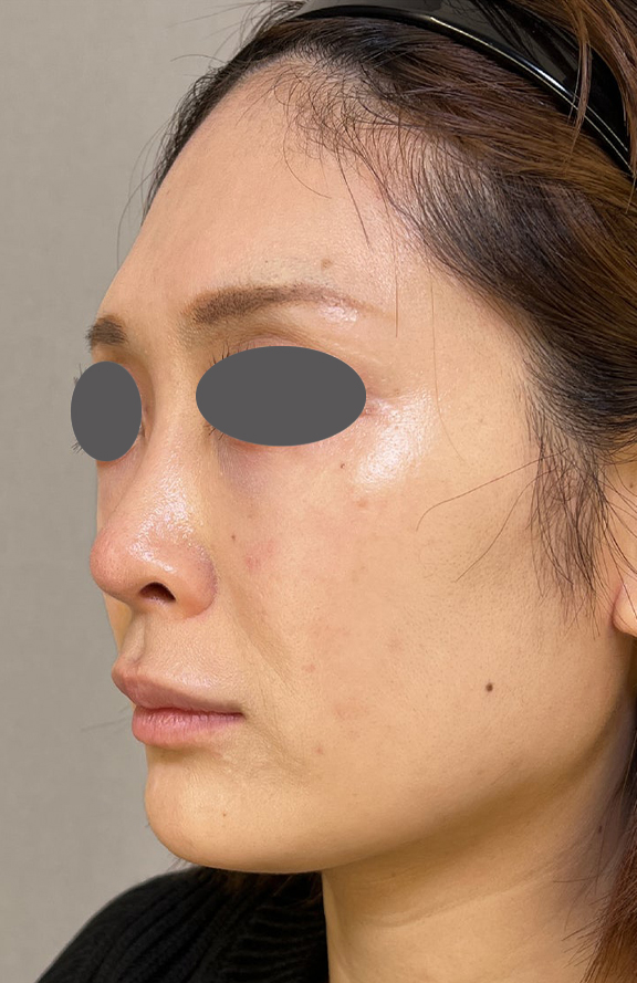 症例写真,耳介軟骨移植でスッキリとした鼻先になった症例写真,After（1ヶ月後）,ba_jikai052_b01.jpg