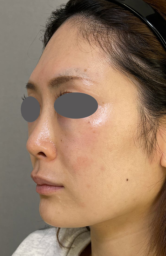 耳介軟骨移植（鼻先を出す）,耳介軟骨移植でスッキリとした鼻先になった症例写真,Before,ba_jikai052_b01.jpg