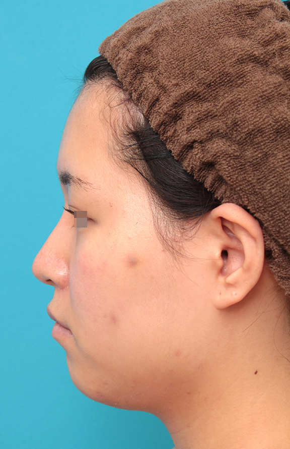 症例写真,鼻シリコンプロテーゼ＋鼻先耳介軟骨移植＋小鼻縮小を行った20代女性の症例写真,After（2ヶ月後）,ba_ryubi1065_b03.jpg