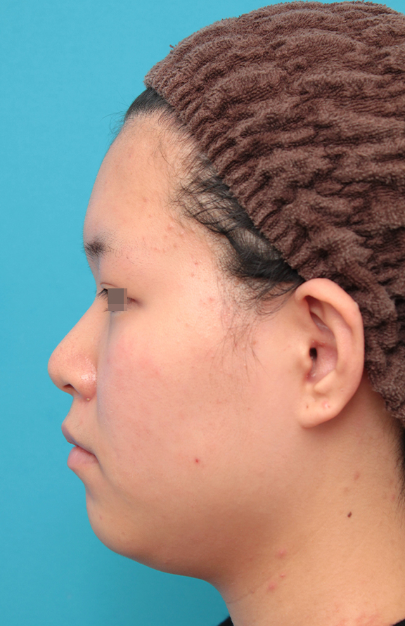 症例写真,鼻シリコンプロテーゼ＋鼻先耳介軟骨移植＋小鼻縮小を行った20代女性の症例写真,Before,ba_ryubi1065_b03.jpg