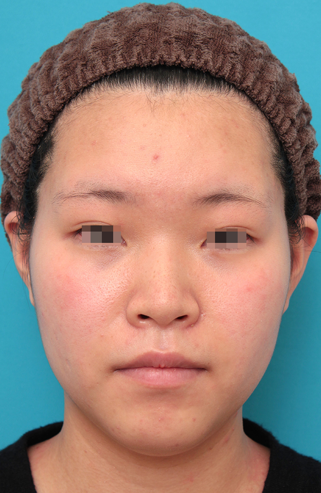 耳介軟骨移植（鼻先を出す）,鼻シリコンプロテーゼ＋鼻先耳介軟骨移植＋小鼻縮小を行った20代女性の症例写真,手術前,mainpic_ryubi1065a.jpg
