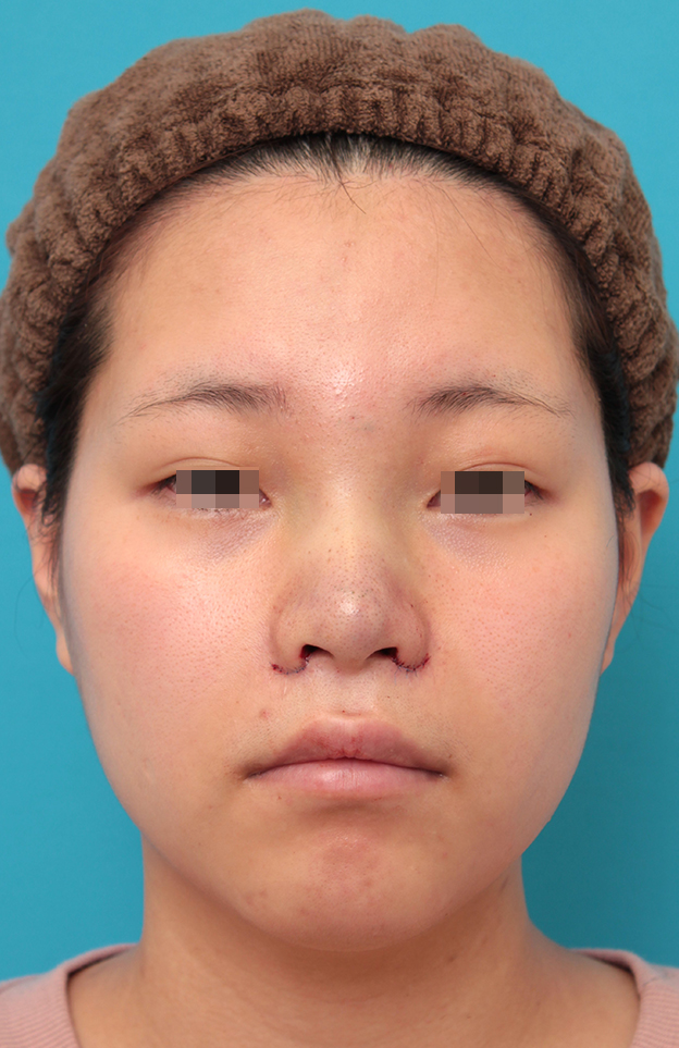 耳介軟骨移植（鼻先を出す）,鼻シリコンプロテーゼ＋鼻先耳介軟骨移植＋小鼻縮小を行った20代女性の症例写真,手術直後,mainpic_ryubi1065b.jpg