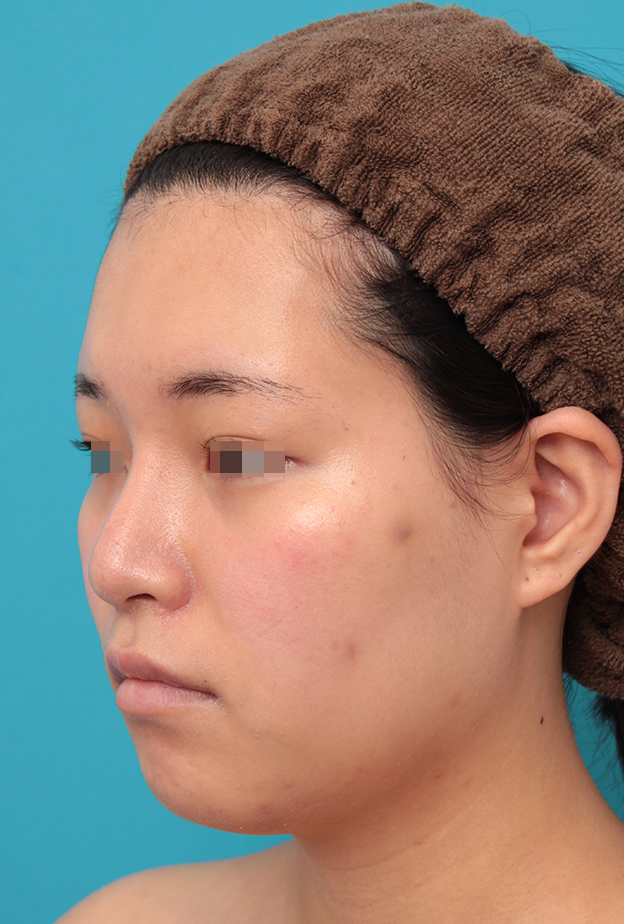 症例写真,鼻シリコンプロテーゼ＋鼻先耳介軟骨移植＋小鼻縮小を行った20代女性の症例写真,2ヶ月後,mainpic_ryubi1065j.jpg