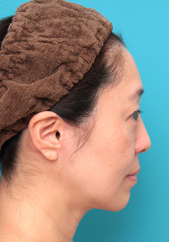 症例写真,ミディアムフェイスリフトを行った50代女性症例写真,After（6ヶ月後）,ba_mediumlift024_b02.jpg