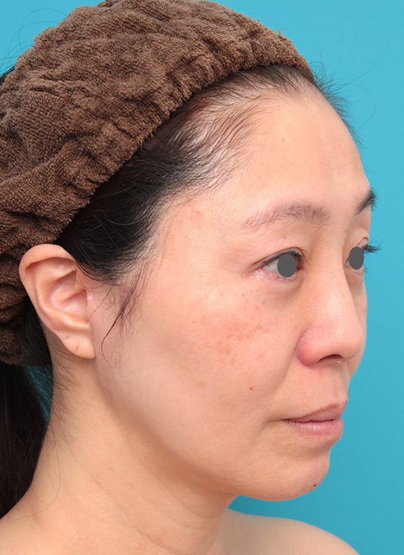 症例写真,ミディアムフェイスリフトを行った50代女性症例写真,After（6ヶ月後）,ba_mediumlift024_b03.jpg