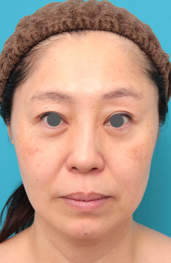 ミディアムフェイスリフトを行った50代女性症例写真,Before,ba_mediumlift024_b01.jpg