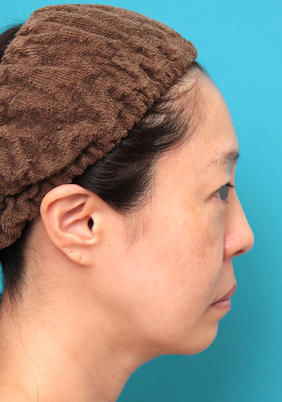 症例写真,ミディアムフェイスリフトを行った50代女性症例写真,Before,ba_mediumlift024_b02.jpg