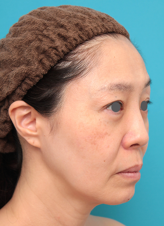 症例写真,ミディアムフェイスリフトを行った50代女性症例写真,Before,ba_mediumlift024_b03.jpg
