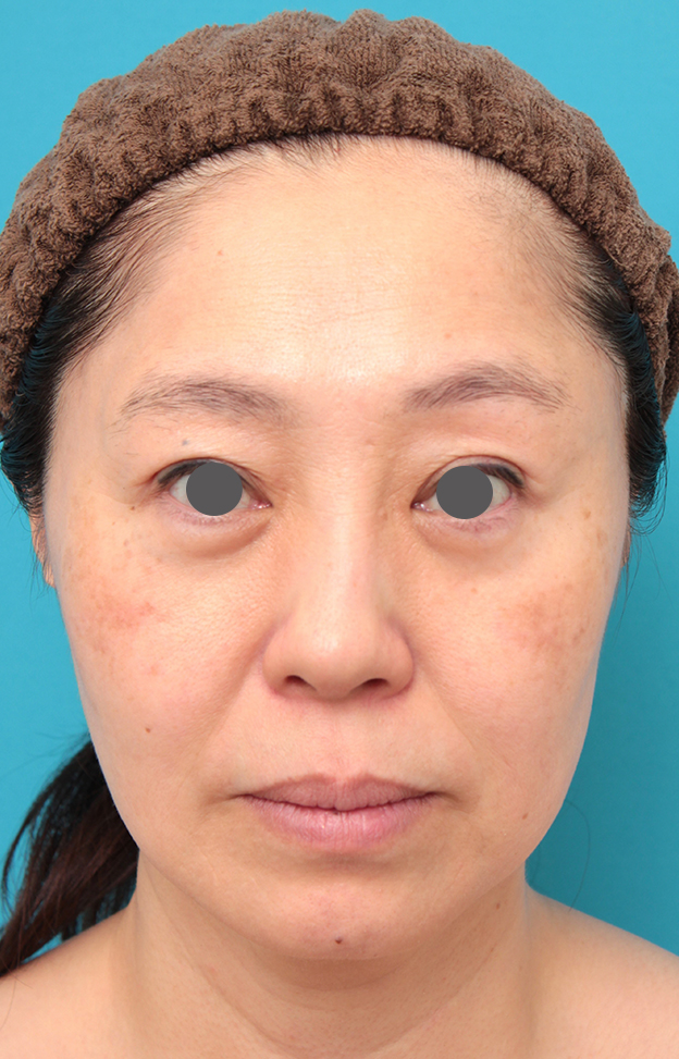 症例写真,ミディアムフェイスリフトを行った50代女性症例写真,手術前,mainpic_mediumlift024a.jpg