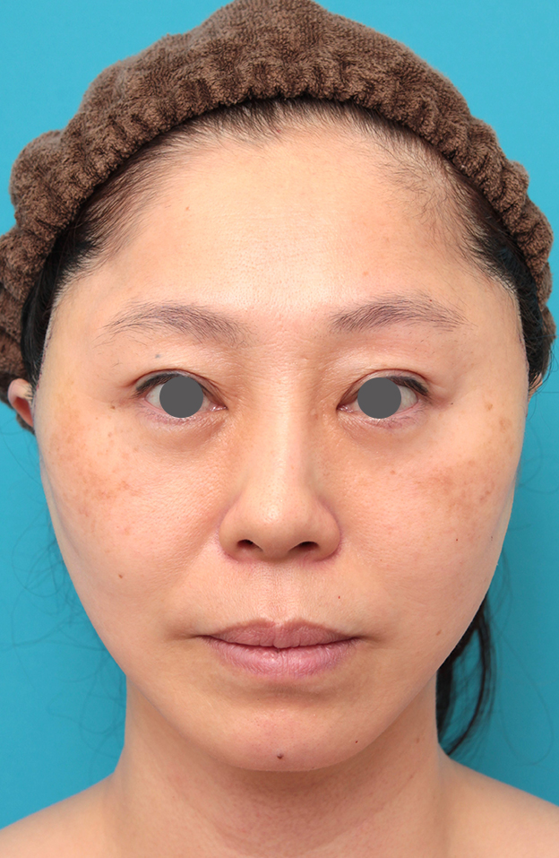 症例写真,ミディアムフェイスリフトを行った50代女性症例写真,手術直後,mainpic_mediumlift024b.jpg