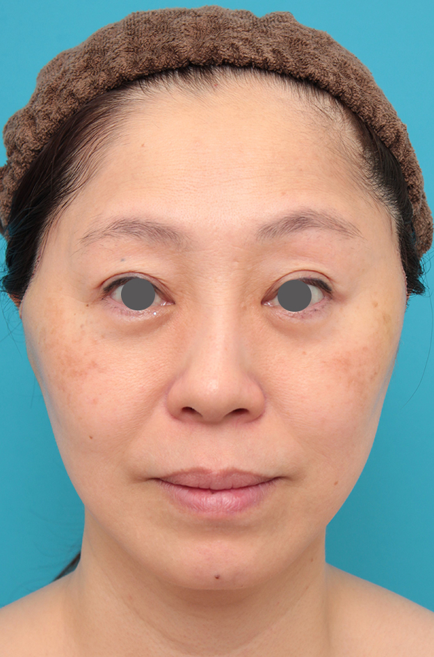 症例写真,ミディアムフェイスリフトを行った50代女性症例写真,1週間後,mainpic_mediumlift024c.jpg