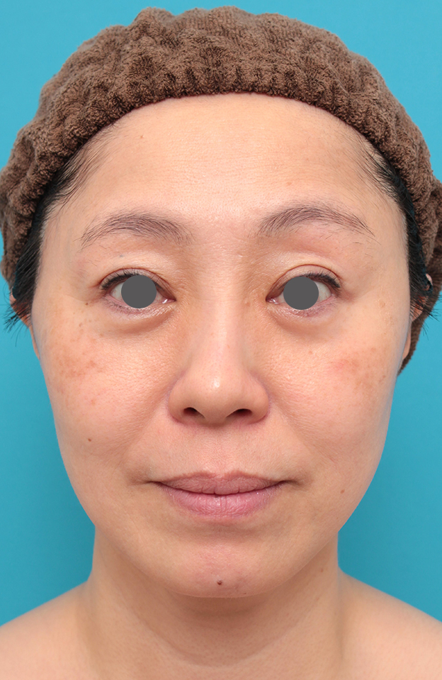 症例写真,ミディアムフェイスリフトを行った50代女性症例写真,3週間後,mainpic_mediumlift024d.jpg