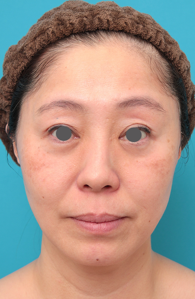 症例写真,ミディアムフェイスリフトを行った50代女性症例写真,6ヶ月後,mainpic_mediumlift024e.jpg
