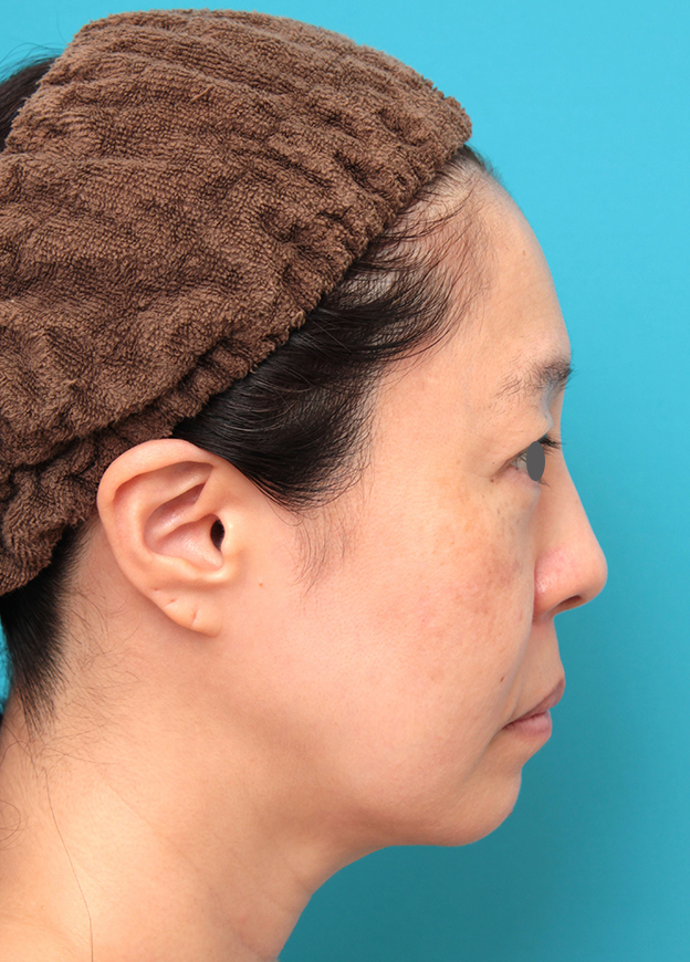 症例写真,ミディアムフェイスリフトを行った50代女性症例写真,手術前,mainpic_mediumlift024f.jpg