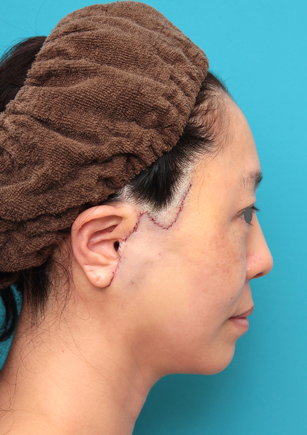 症例写真,ミディアムフェイスリフトを行った50代女性症例写真,手術直後,mainpic_mediumlift024g.jpg