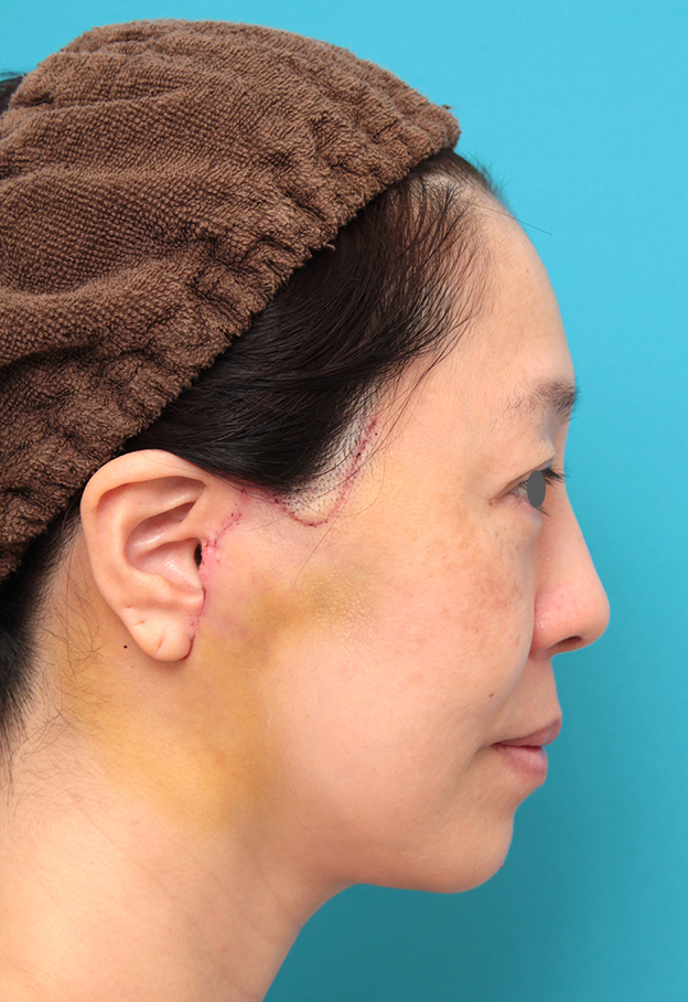 症例写真,ミディアムフェイスリフトを行った50代女性症例写真,1週間後,mainpic_mediumlift024h.jpg