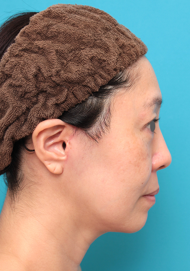 症例写真,ミディアムフェイスリフトを行った50代女性症例写真,3週間後,mainpic_mediumlift024i.jpg