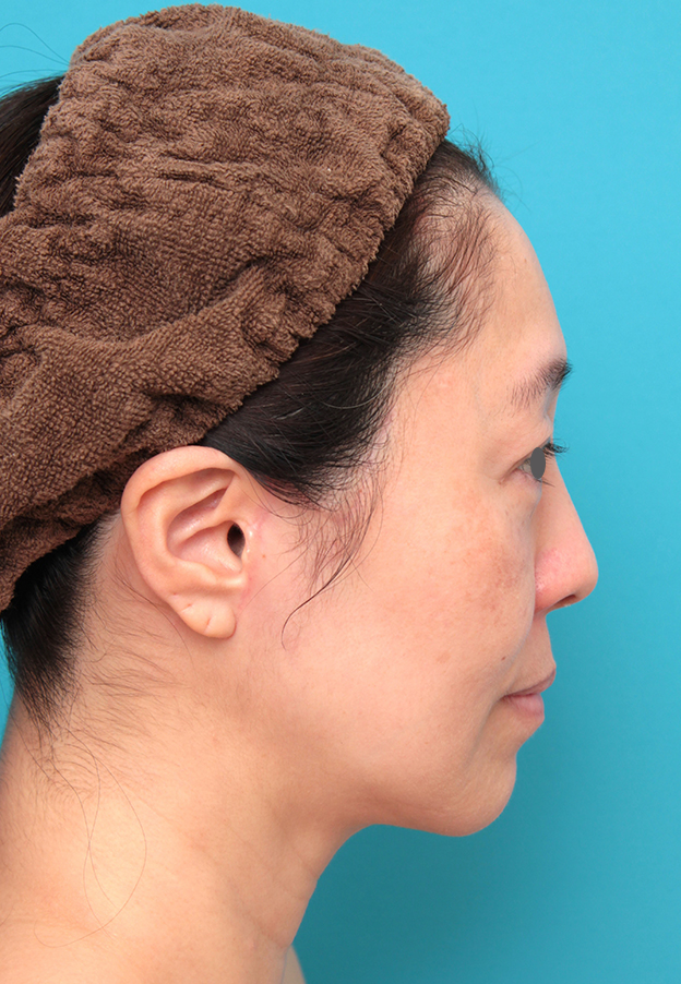 症例写真,ミディアムフェイスリフトを行った50代女性症例写真,6ヶ月後,mainpic_mediumlift024j.jpg