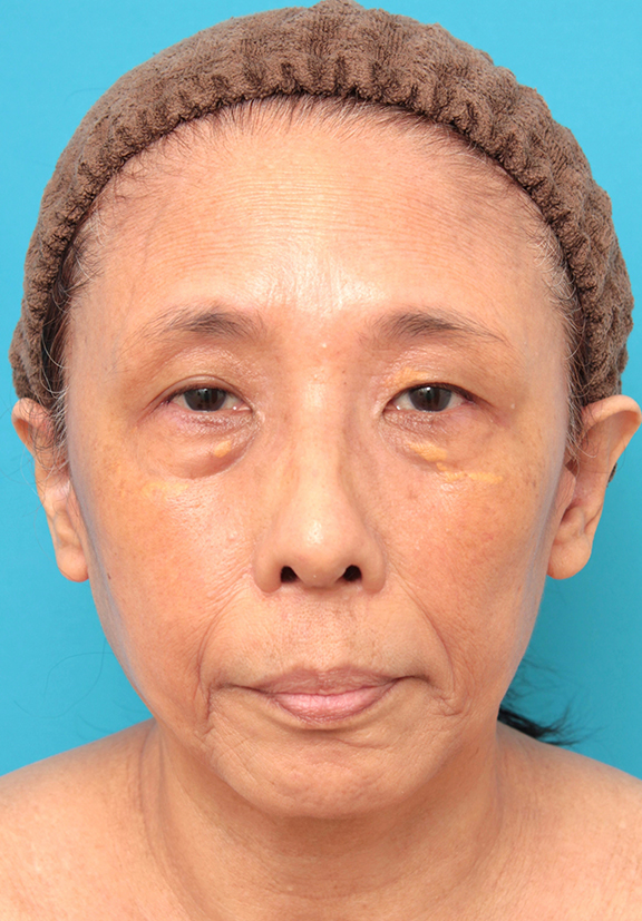 フェイスリフトを行った60代女性症例写真,After（6ヶ月後）,ba_facelift008_a01.jpg