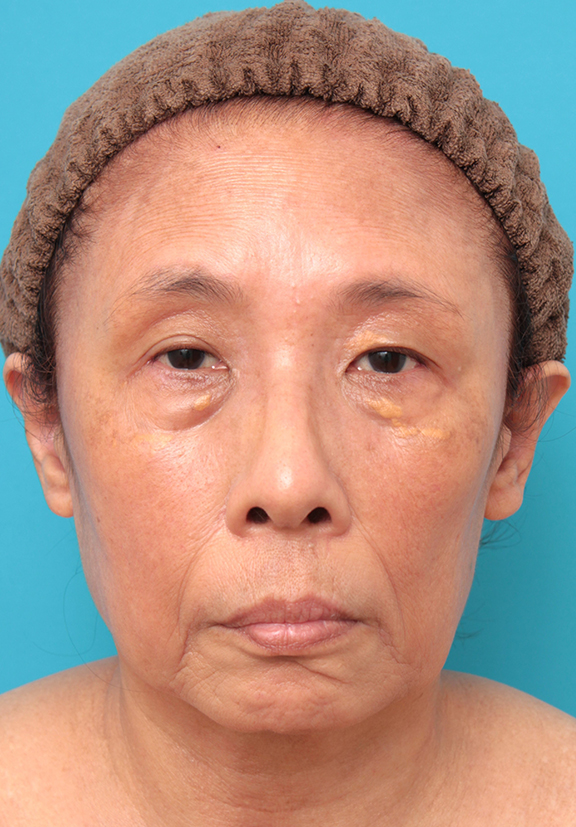 フルフェイスリフト,フェイスリフトを行った60代女性症例写真,Before,ba_facelift008_b01.jpg