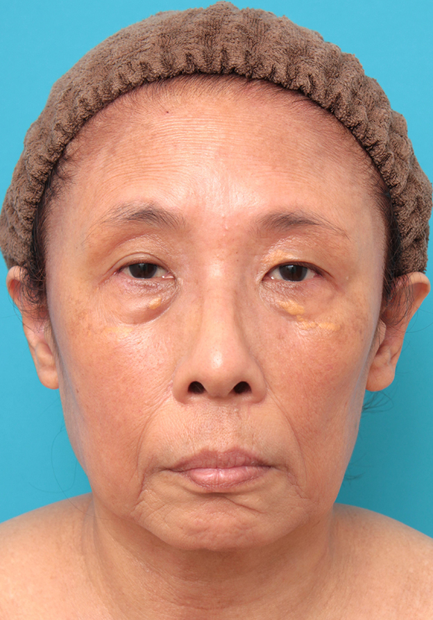 症例写真,フェイスリフトを行った60代女性症例写真,手術前,mainpic_facelift008a.jpg