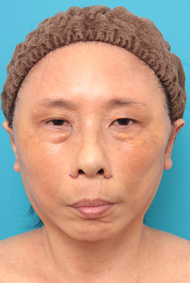 症例写真,フェイスリフトを行った60代女性症例写真,手術直後,mainpic_facelift008b.jpg