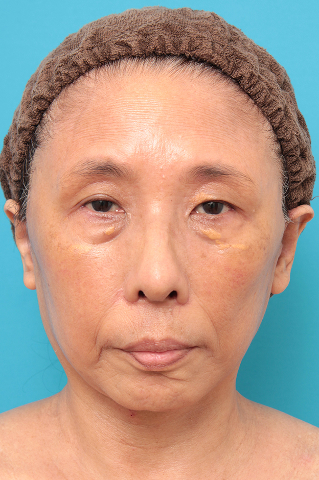 症例写真,フェイスリフトを行った60代女性症例写真,1週間後,mainpic_facelift008c.jpg