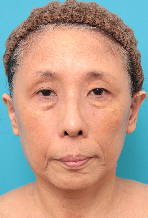 症例写真,フェイスリフトを行った60代女性症例写真,3週間後,mainpic_facelift008d.jpg