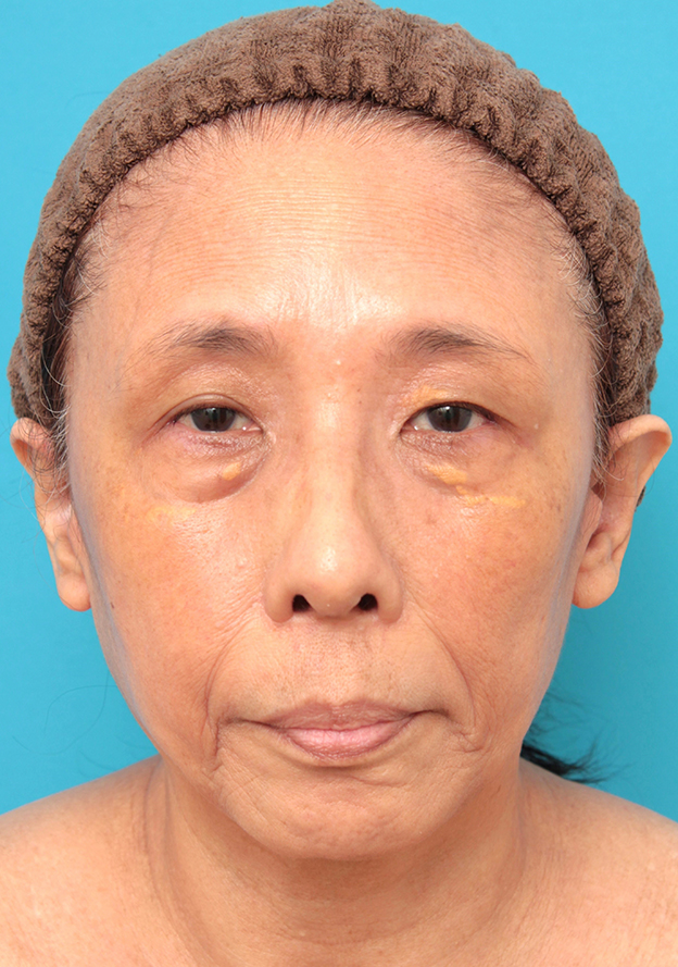 症例写真,フェイスリフトを行った60代女性症例写真,6ヶ月後,mainpic_facelift008e.jpg