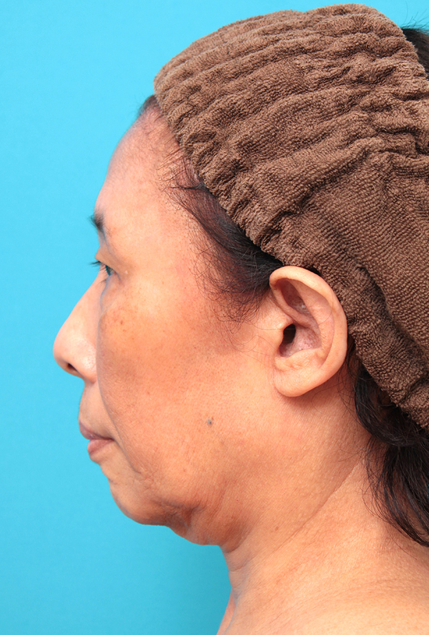 症例写真,フェイスリフトを行った60代女性症例写真,手術前,mainpic_facelift008f.jpg