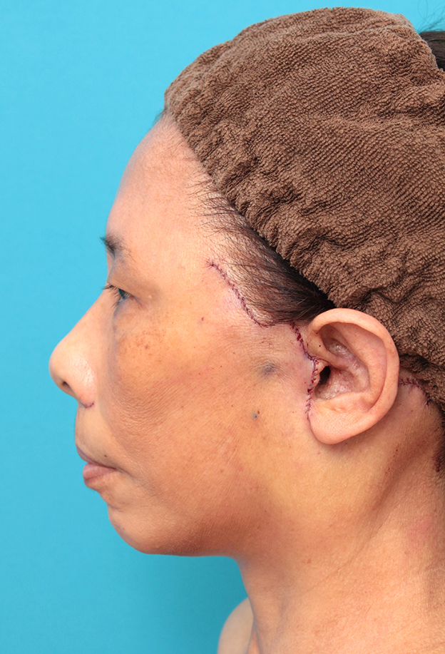 症例写真,フェイスリフトを行った60代女性症例写真,手術直後,mainpic_facelift008g.jpg