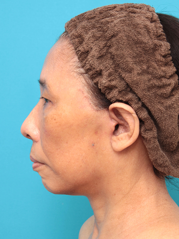症例写真,フェイスリフトを行った60代女性症例写真,1週間後,mainpic_facelift008h.jpg