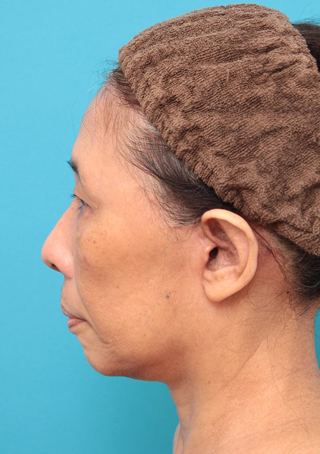 症例写真,フェイスリフトを行った60代女性症例写真,3週間後,mainpic_facelift008i.jpg