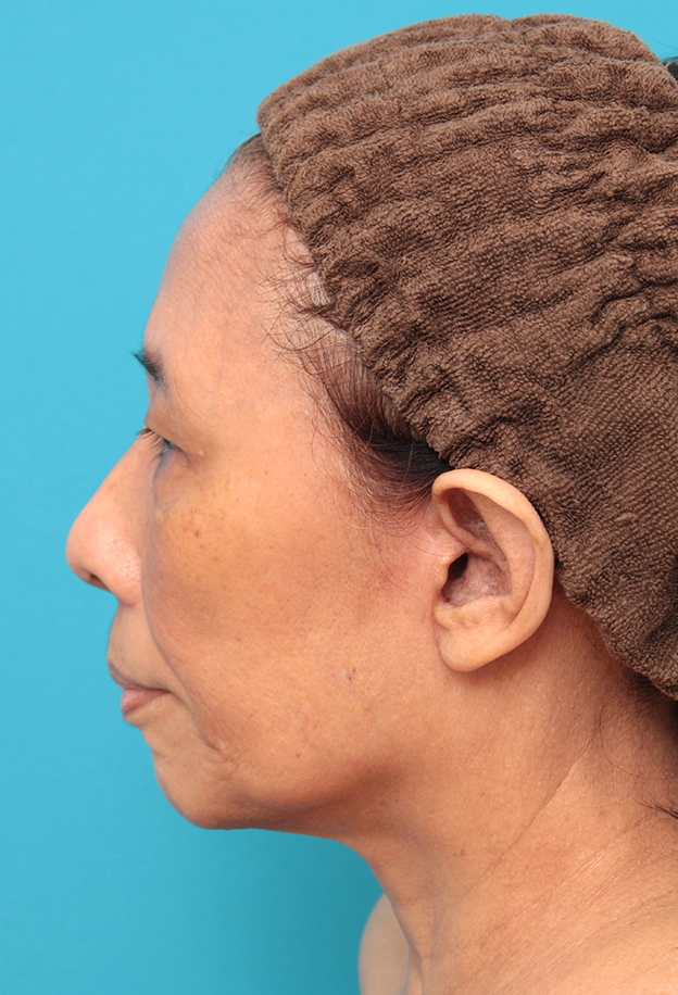 症例写真,フェイスリフトを行った60代女性症例写真,6ヶ月後,mainpic_facelift008j.jpg