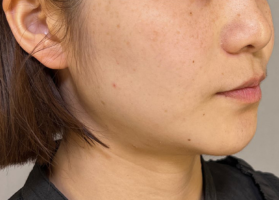 症例写真,ウルセラシステムとエラボトックスでフェイスラインをすっきりさせた症例写真,Before,ba_ulthera039_b02.jpg