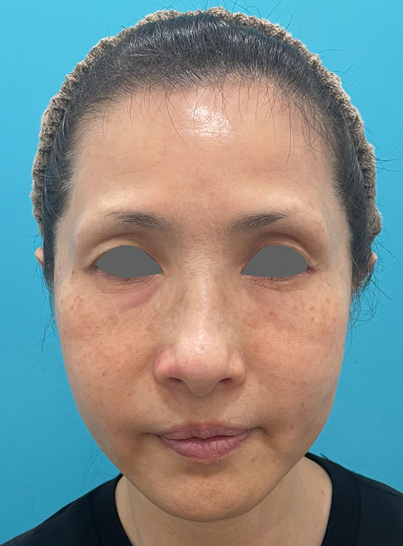 症例写真,フォトフェイシャルM22でシミを改善した症例写真,After(3回施術1ヶ月後),ba_ipl014_b01.jpg