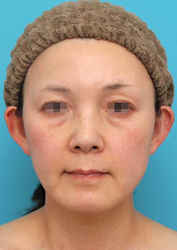 ミニフェイスリフトを行った50代女性症例写真,After（6ヶ月後）,ba_minilift019_a01.jpg