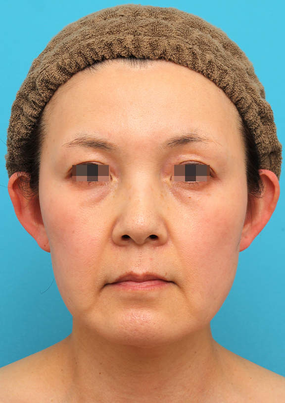 ミニフェイスリフトを行った50代女性症例写真,Before,ba_minilift019_b01.jpg