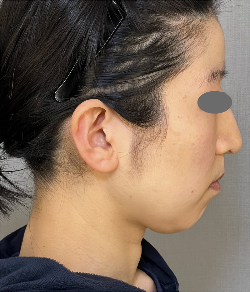あご注射（ヒアルロン酸）,脂肪吸引（頬、あご下）,ミニフェイスリフト（頬のたるみ取り）,脂肪吸引,ミニリフト、脂肪吸引、あごヒアルロン酸でフェイスラインをすっきりさせ、1年後も効果が持続している症例写真,Before,ba_minilift021_b01.jpg