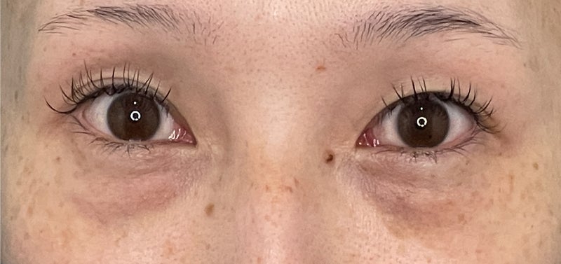 目の下の脂肪取り,CO2レーザーを使った目の下の切らない脂肪取りの症例写真,After（1ヶ月後）,ba_shibo_under014_a01.jpg
