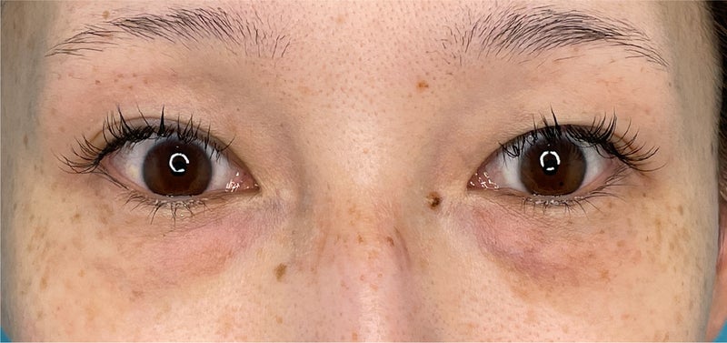 目の下の脂肪取り,CO2レーザーを使った目の下の切らない脂肪取りの症例写真,Before,ba_shibo_under014_b01.jpg