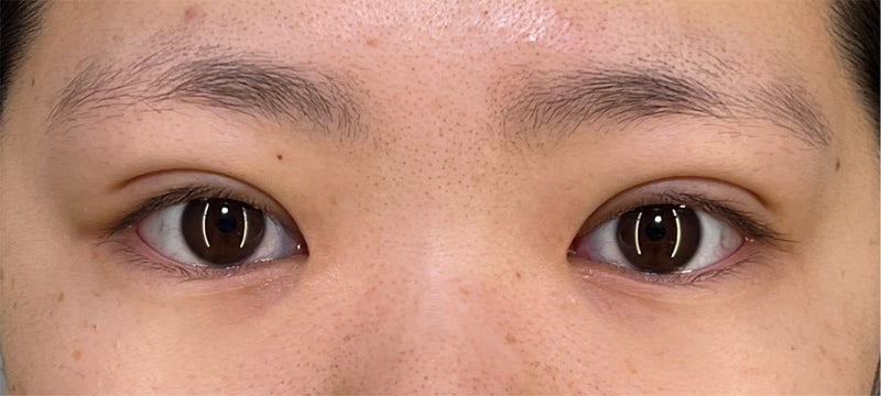 二重まぶた･埋没法（一針固定）で眠たそうなまぶたを改善した症例写真,After（メイクなし）
（1ヶ月後）,ba_maibotsu079_a01.jpg