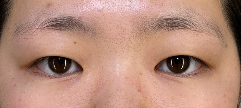 二重まぶた･埋没法（一針固定）で眠たそうなまぶたを改善した症例写真,Before,ba_maibotsu079_b01.jpg
