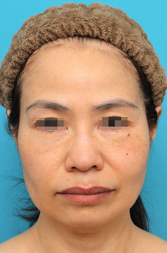 ミディアムフェイスリフトを行った50代女性の症例写真,Before,ba_mediumlift025_b01.jpg