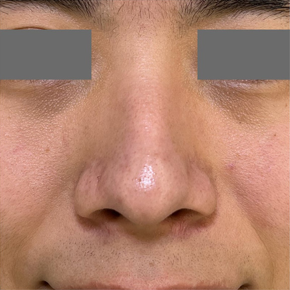 鼻翼縮小の内外側法で手術を行った症例写真,Before,ba_biyoku059_b01.jpg