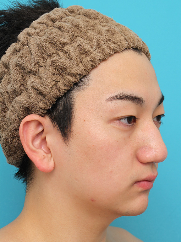 垂れ鼻修正手術,垂れ鼻修正+鼻尖縮小+小鼻縮小を行った20代男性の症例写真,After（6ヶ月後）,ba_tarebana002_b02.jpg