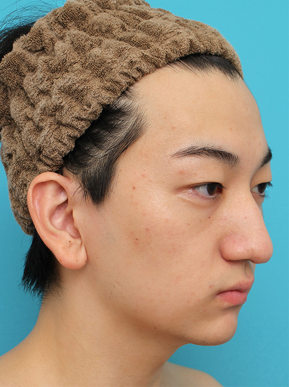 垂れ鼻修正手術,垂れ鼻修正+鼻尖縮小+小鼻縮小を行った20代男性の症例写真,Before,ba_tarebana002_b02.jpg