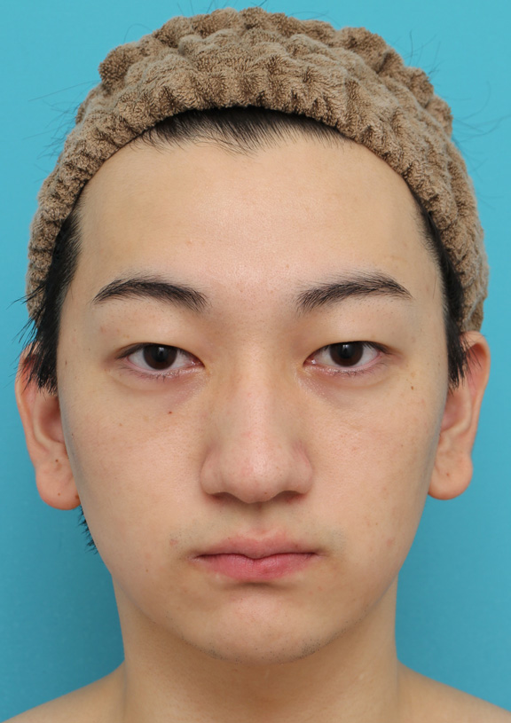 垂れ鼻修正手術,垂れ鼻修正+鼻尖縮小+小鼻縮小を行った20代男性の症例写真,手術前,mainpic_tarebana002a.jpg