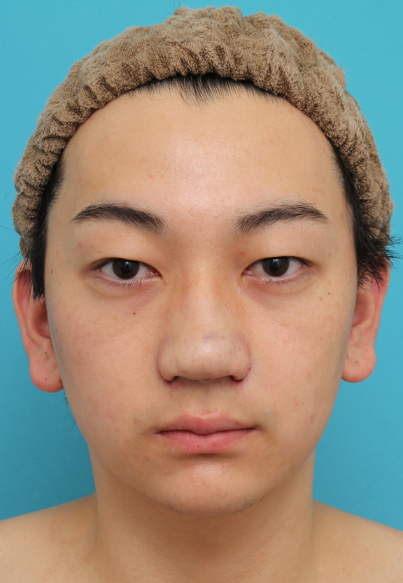 垂れ鼻修正手術,垂れ鼻修正+鼻尖縮小+小鼻縮小を行った20代男性の症例写真,手術直後,mainpic_tarebana002b.jpg
