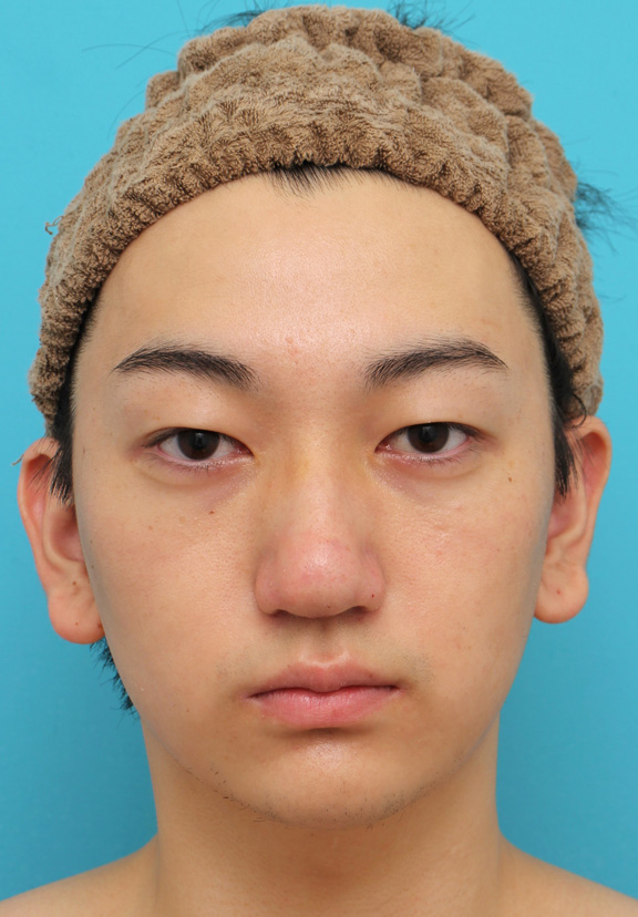垂れ鼻修正手術,垂れ鼻修正+鼻尖縮小+小鼻縮小を行った20代男性の症例写真,1週間後,mainpic_tarebana002c.jpg